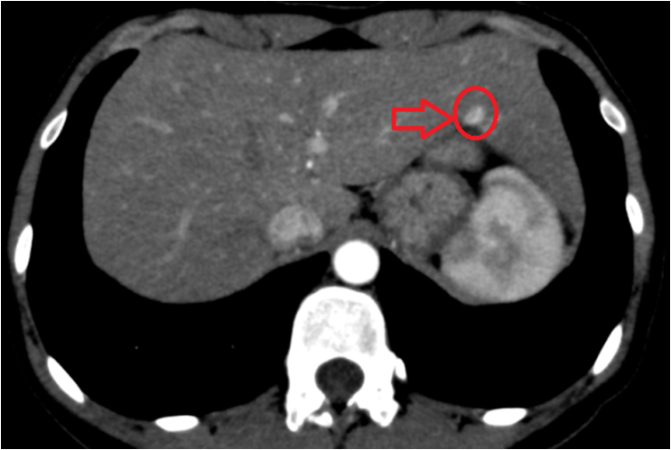 복부CT: 간 왼쪽엽 병변 (빨간 동그라미 표시)