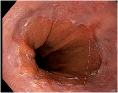 흉통 → 식도궤양 #가슴통증 #소화기질환