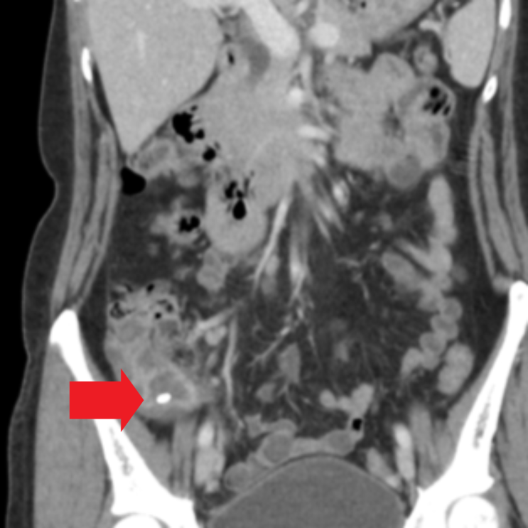 복부CT: 충수결석을 동반한 충수돌기 벽 비후 (화살표 표시)