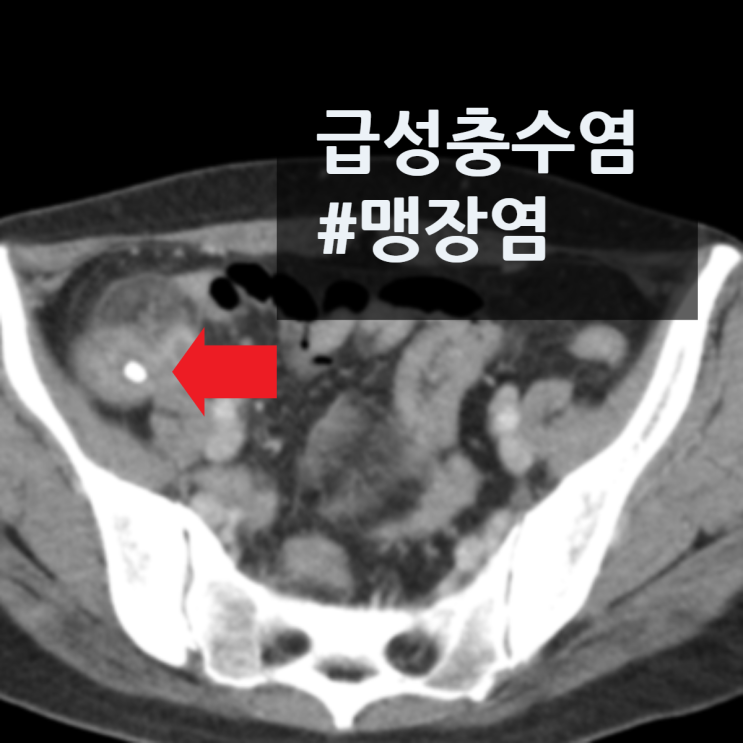 복부CT: 급성충수염 #맹장염 소견