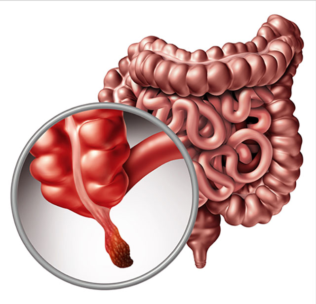 충수염 해부도 참고자료