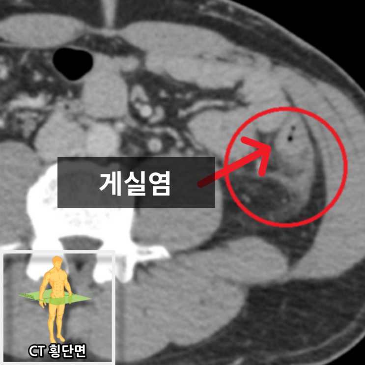 복부CT: 좌하복부 대장게실 염증소견 (화살표 표시)