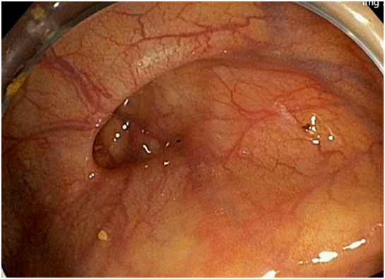 오른쪽아랫배 통증 대장게실염 진단사례 링크