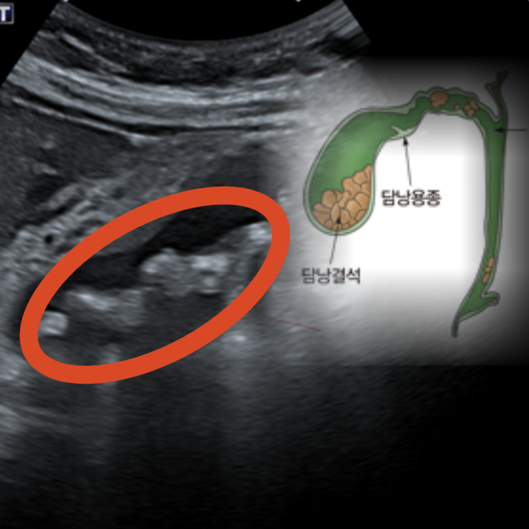 오른쪽 윗배 통증 → 급성 담낭염