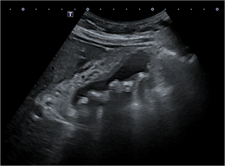 복부초음파: 결석성담낭염 소견 (컬러도플러)