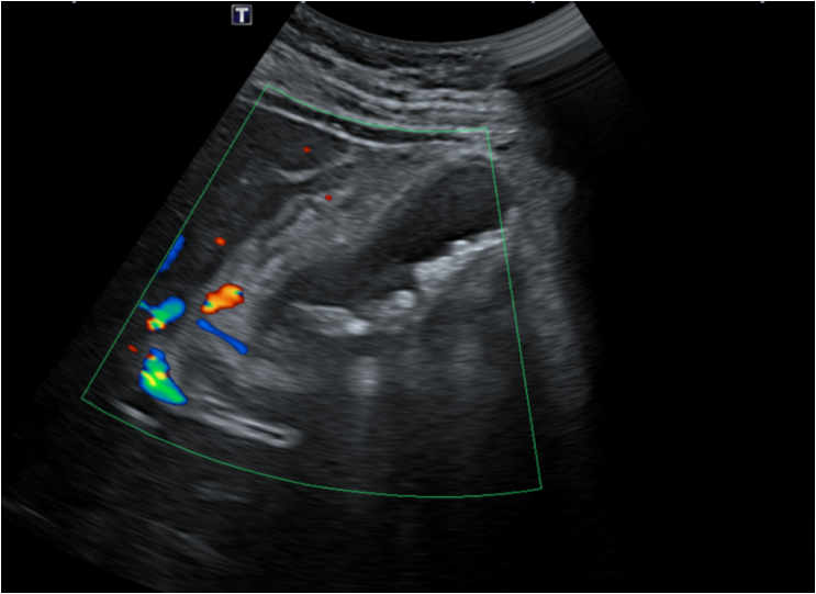 담낭 해부도 참고자료 (담관, 담낭용종, 담낭결석)