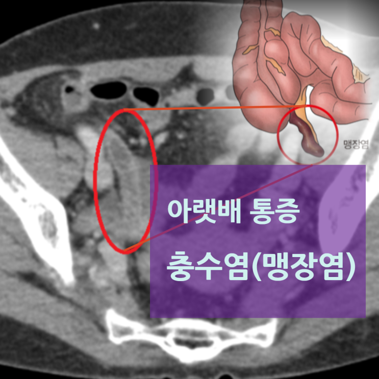 복부CT: 충수 늘어남 및 주변 염증 반응 (빨간 동그라미)