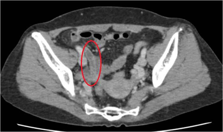 혈액검사: Segment neutrophil 78.0% (감염/염증 수치)