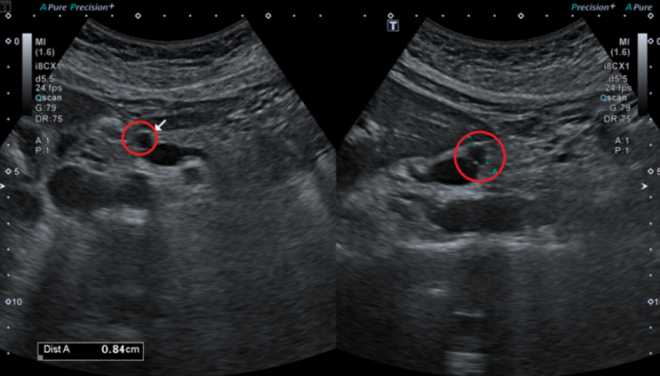 췌장MRI: 췌장 머리쪽 8mm 물혹 (빨간 동그라미)