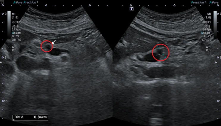 췌장MRI: 췌장 머리쪽 8mm 물혹 (빨간 동그라미)