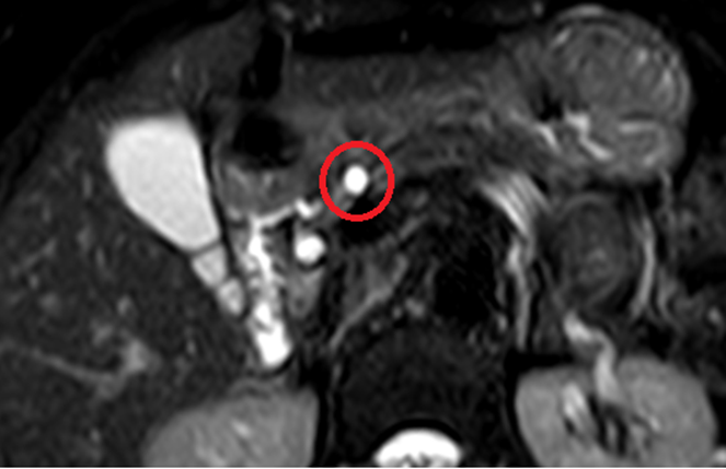 췌장낭종 종류 참고자료 (Mayo Foundation)