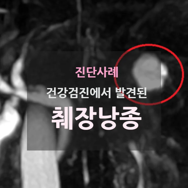 건강검진에서 발견된 췌장낭종 → 췌관내 유두점액종양 #췌장물혹