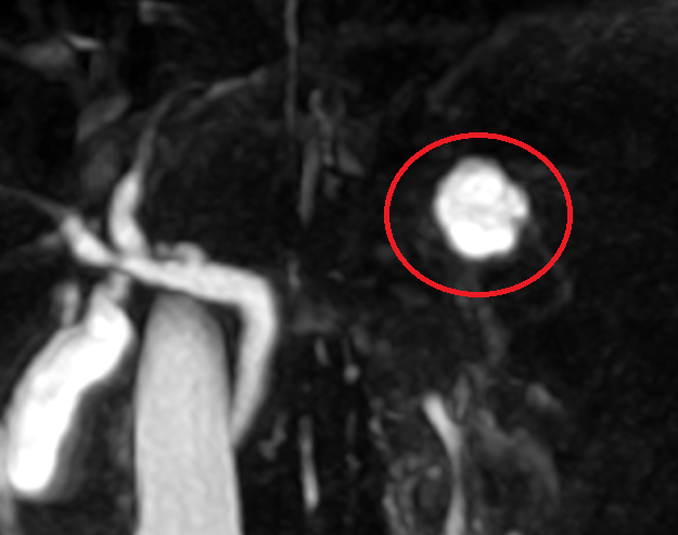 췌장MRI: 췌관 연결성 확인