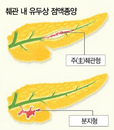 췌관 내 유두상 점액종양 참고자료 (주체관형, 분지형)