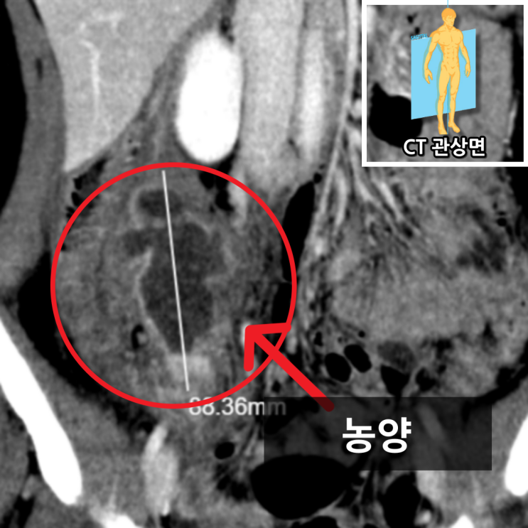 충수염 해부도 참고자료
