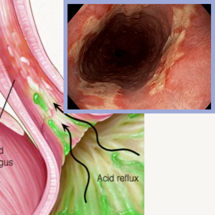 위내시경: 식도 Acid reflux 소견