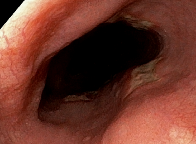 위내시경: 식도 궤양 소견