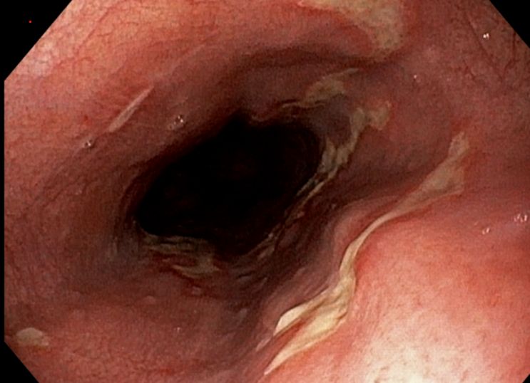 위내시경: 다발성 식도궤양 확대