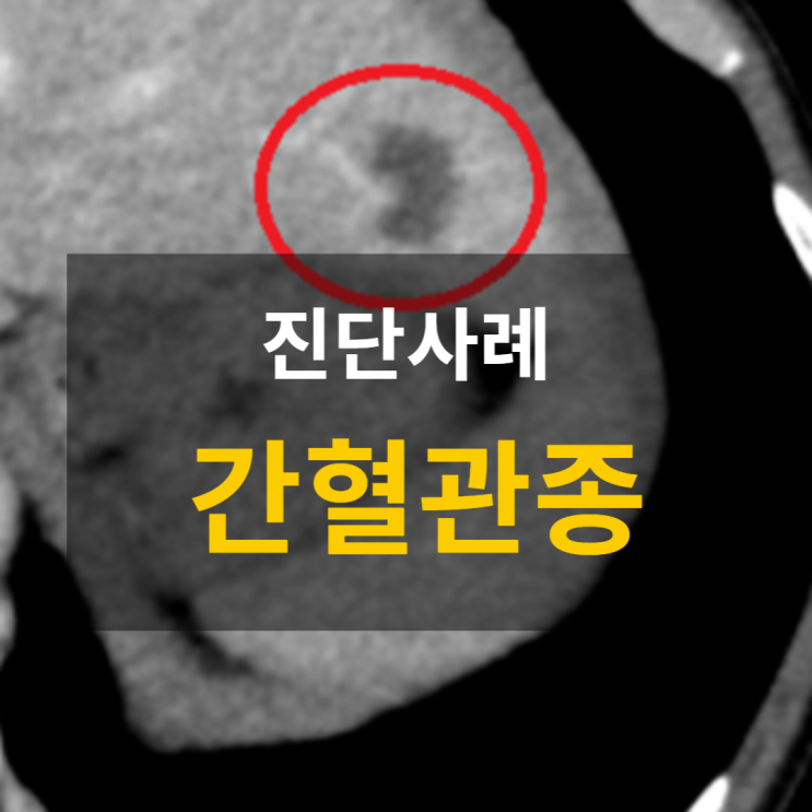 소화불량, 갈비뼈 통증 — 간혈관종 진단