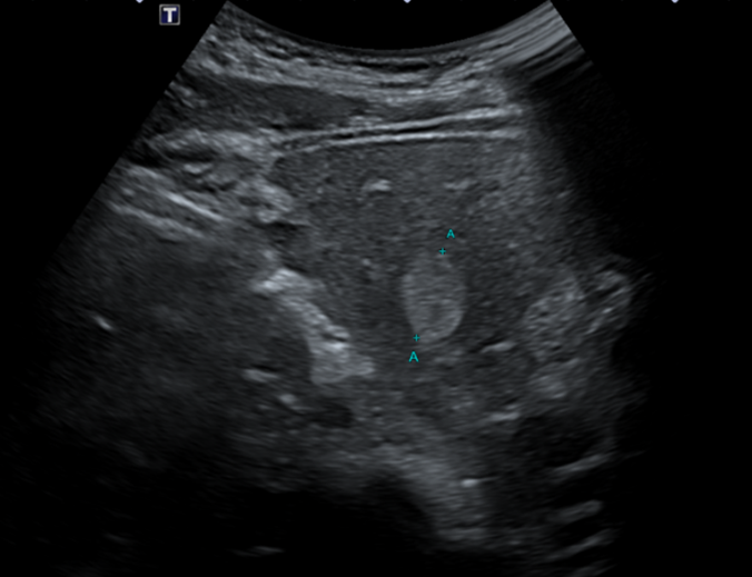 복부CT: 간혈관종 병변 확인(빨간 동그라미)