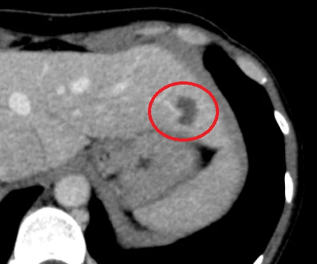 간혈관종(Hemangioma) 참고 해부도