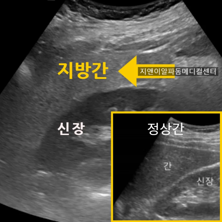 간수치 상승, 피로감 — 중등도 지방간 진단