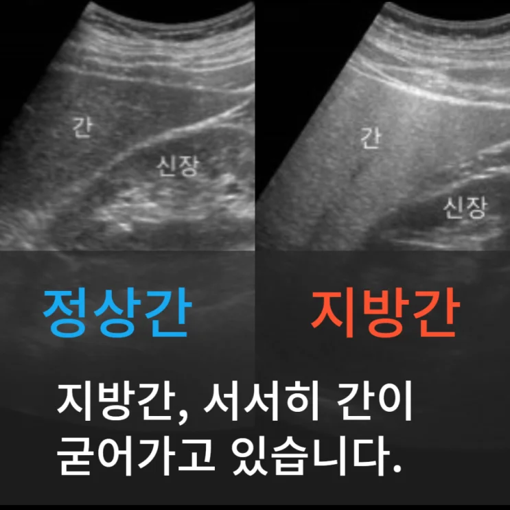 간수치검사 결과 (AST 49, ALT 65)