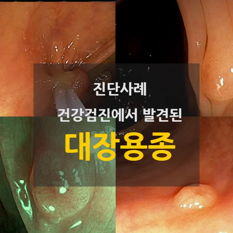 건강검진 대장내시경 — 대장용종 다수 발견