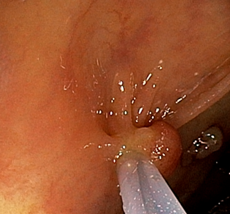 대장내시경: 다발성 용종 확인 (NBI 모드)