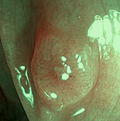 대장내시경: 추가 용종 확인