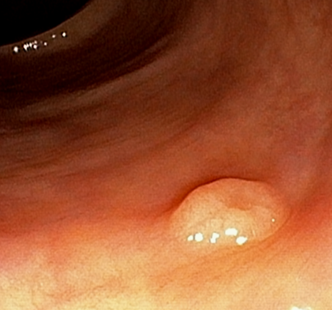 대장용종 → 대장암 진행과정 참고자료