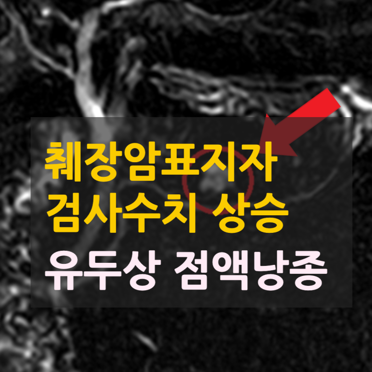 CA19-9(췌장암표지자) 상승 — 췌관내유두점액낭종 진단
