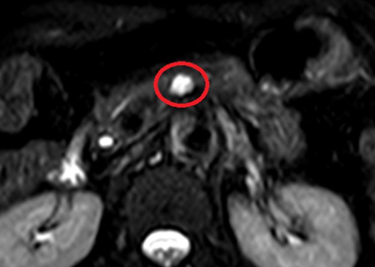 췌장MRI: 췌장담도와 연결성 확인(빨간 동그라미)