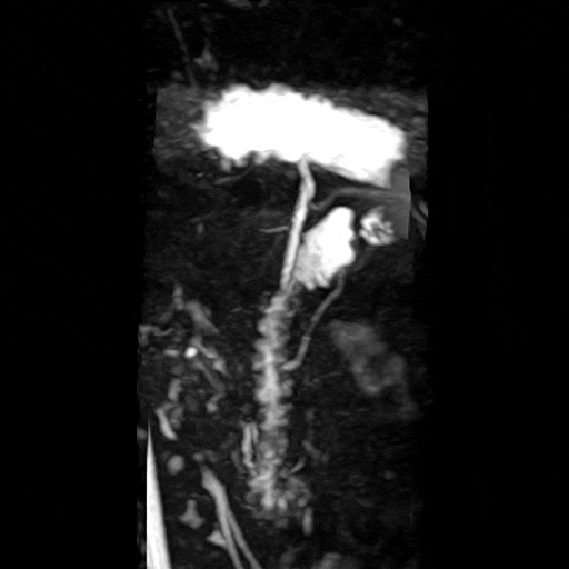 췌장MRI: 8mm 미세병변