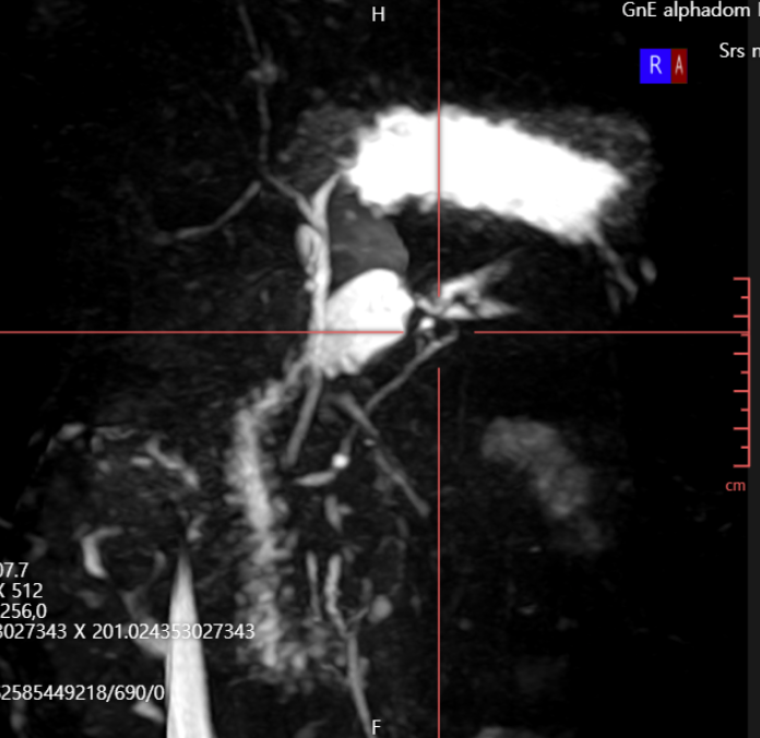 췌장MRI: 관상면 영상