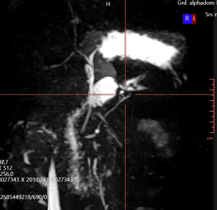 췌장MRI: 관상면 영상