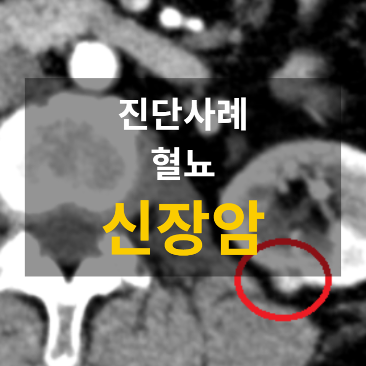 복부CT 횡단촬영: 신장 병변