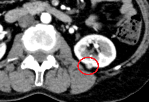 복부CT 종단촬영: 신장암 확인