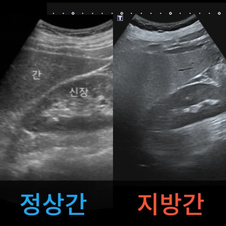 간기능 혈액검사 결과
