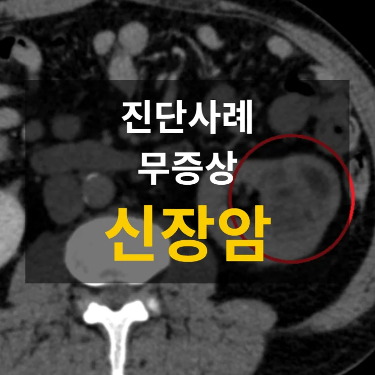 우연히 발견된 신장 결절 — 복부CT에서 확인된 신장암 #검사방법