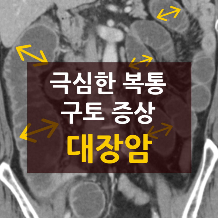 복부CT 횡단: 상행결장 종양 소견