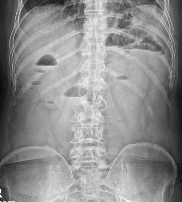 복부 X-ray: 사다리 징후