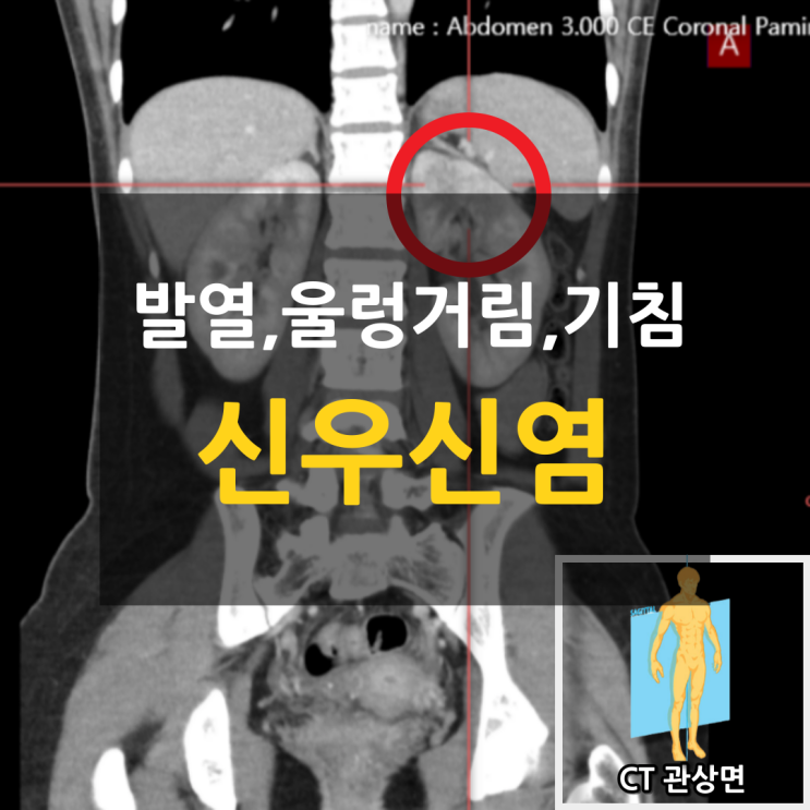 발열, 울렁거림, 해열제 복용 — 신우신염 진단