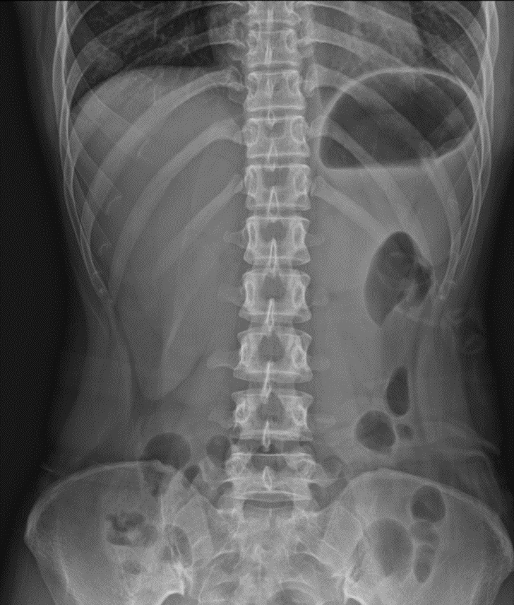 X-RAY: 복부 단순촬영