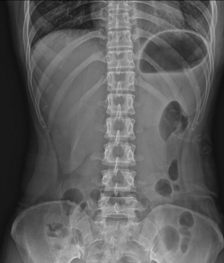 X-RAY: 복부 단순촬영