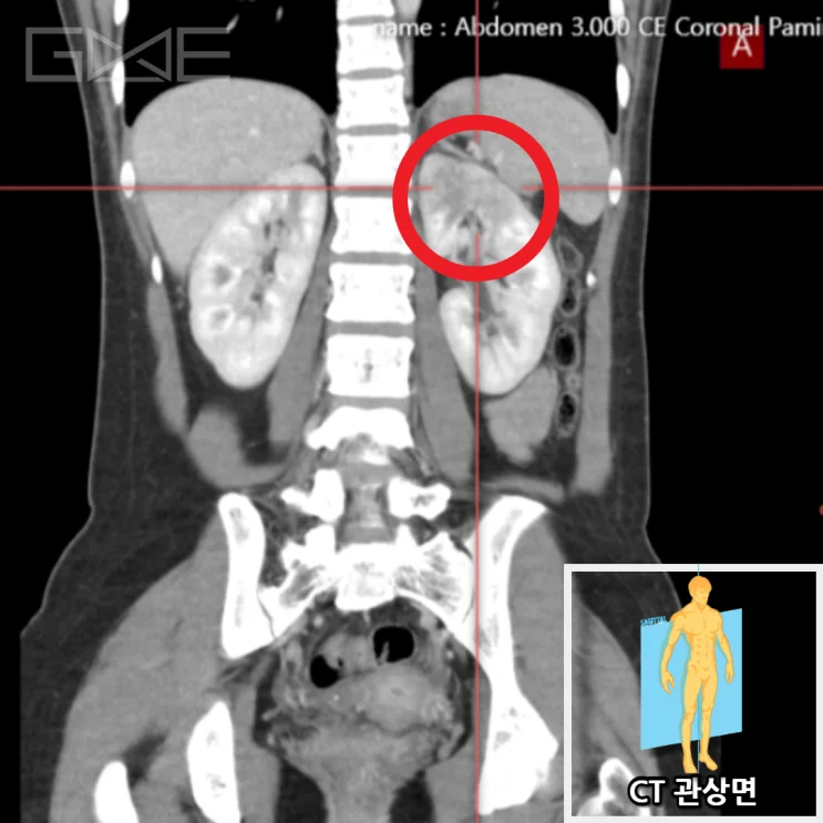 복부CT 관상면: 왼쪽 신장 염증소견(빨간 동그라미)