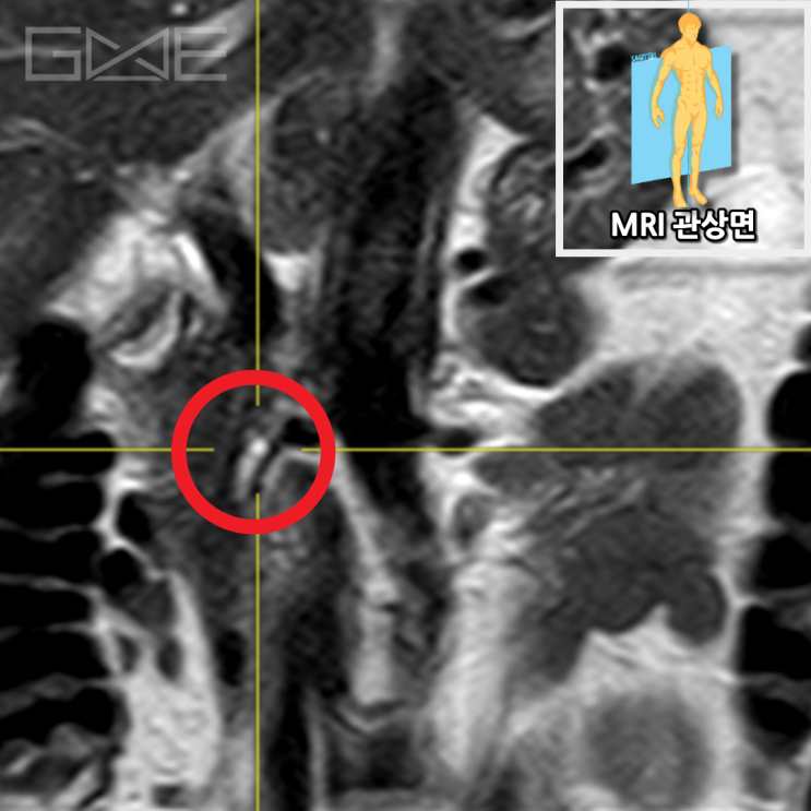 췌장MRI 관상면: 췌장구상돌기 부위 물혹(빨간 동그라미)