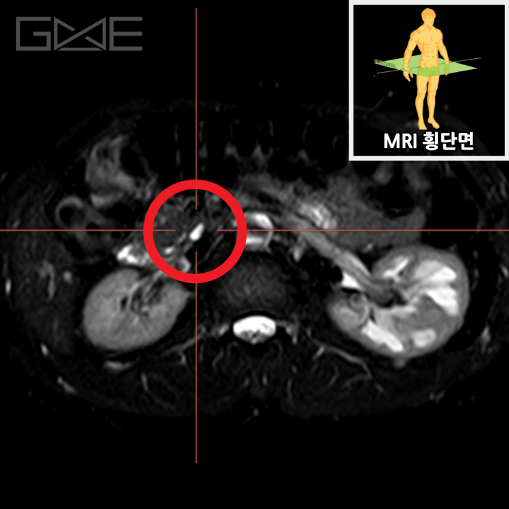 췌장MRI 횡단면: 물혹 확인(빨간 동그라미)