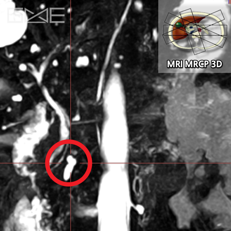 MRI MRCP 3D: 췌장담도와 연결성 확인(빨간 동그라미)