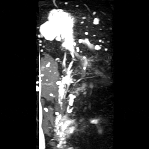 췌장 낭성 종양 분류 참고자료